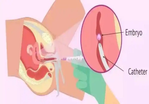 偶發(fā)還是遺傳？看看4號(hào)染色體三體異?，F(xiàn)象的真正原因