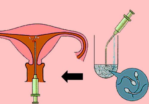 盤(pán)點(diǎn)試管嬰兒希愛(ài)力的正確使用方法，注意時(shí)間和劑量才是關(guān)鍵