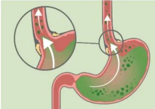 寧波供卵試管：做試管需要對精子怎么處理，需要預(yù)洗嗎
